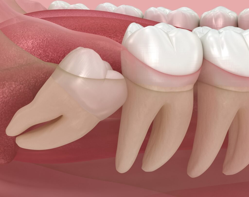 Wisdom Teeth Removal in Woodland Hills
